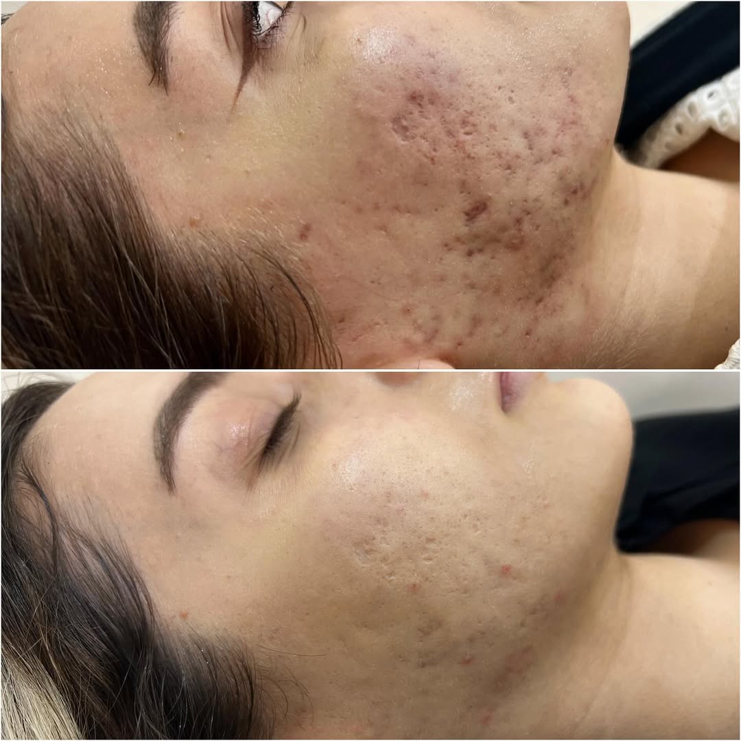 قبل و بعد درمان جای جوش با آر اف فرکشنال